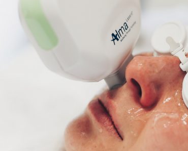 Gesichtsrötungen lasern: Meine Erfahrungen + Vorher-Nachher Bilder! Gesichtsrötungen lasern: Meine Erfahrungen + Vorher-Nachher Bilder!