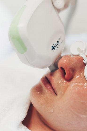 Gesichtsrötungen lasern: Meine Erfahrungen + Vorher-Nachher Bilder! Gesichtsrötungen lasern: Meine Erfahrungen + Vorher-Nachher Bilder!