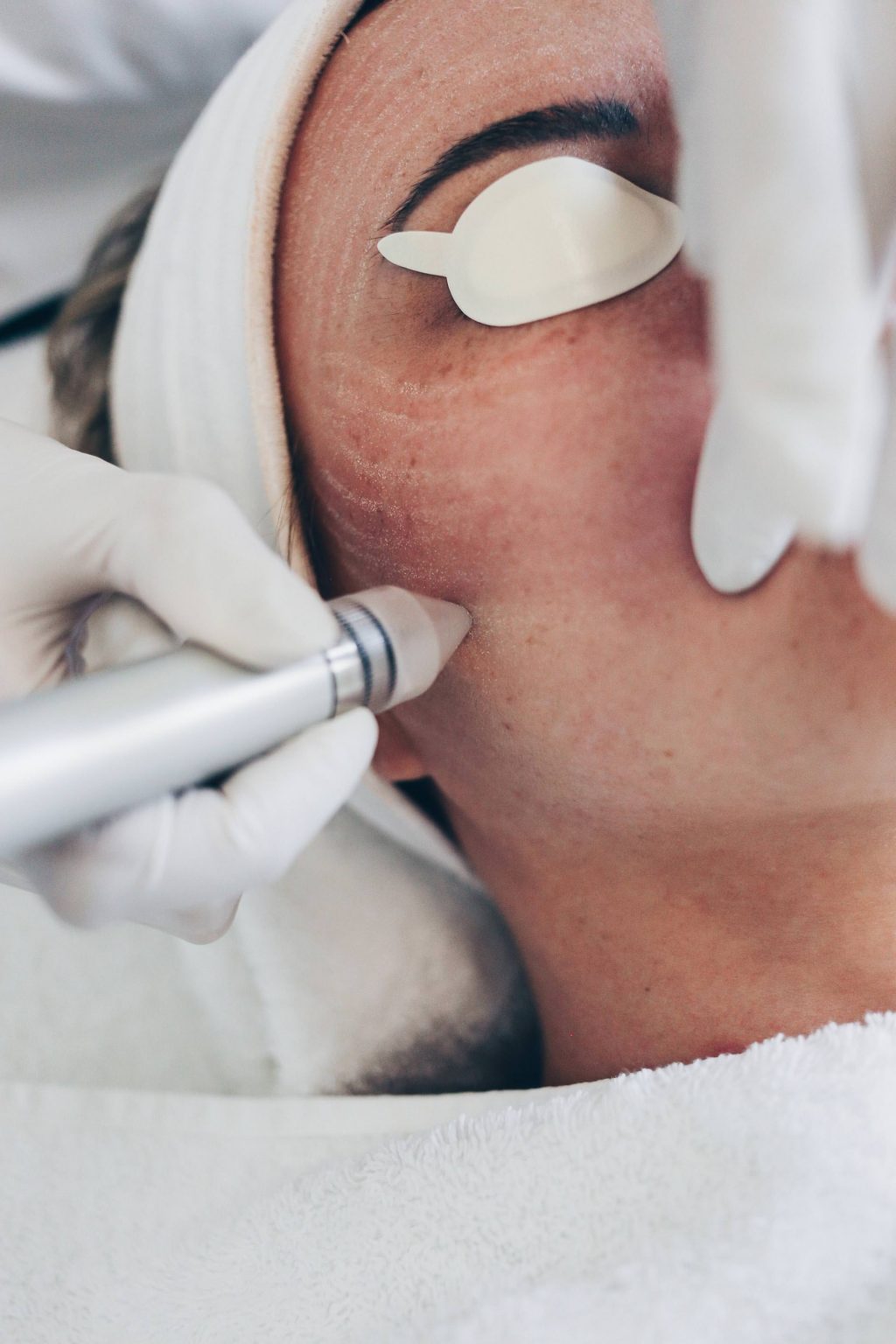 Microdermabrasion und Laserbehandlung für eine feinporige Haut! Life und Style Blog aus Österreich